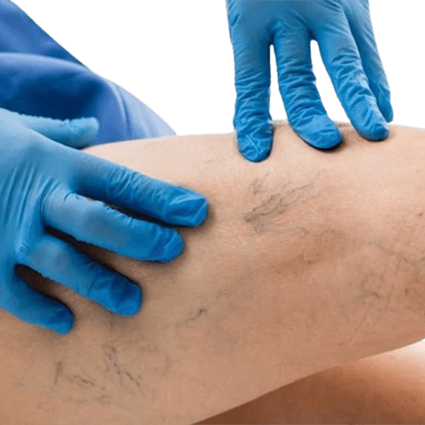 Uterine Fibroid Embolization Patient