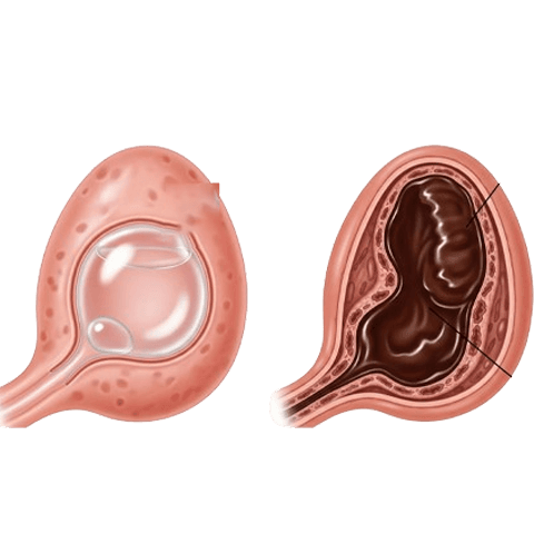 Uterine Fibroid Embolization Patient