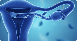 Fallopian Tube Recanalization