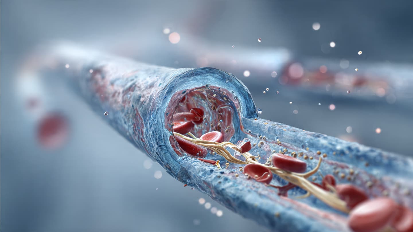 Peripheral Vascular Disease