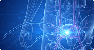 UFE (Fibroids) Treatment