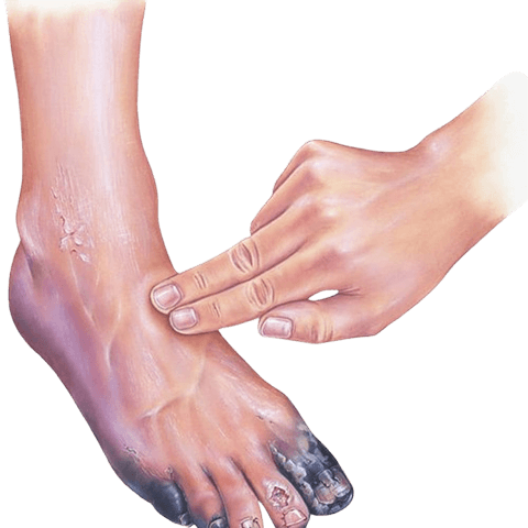 Uterine Fibroid Embolization Patient