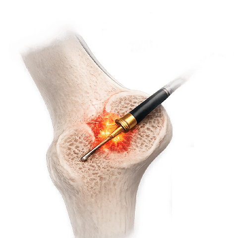Uterine Fibroid Embolization Patient