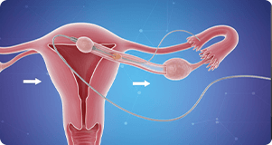 Requires NO general anesthesia (only local anesthesia)