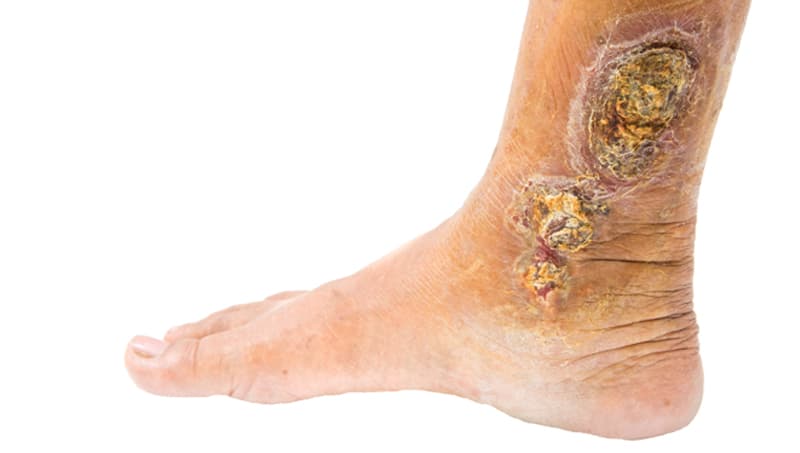 Am I in Danger if I don’t Treat My Varicose Veins?